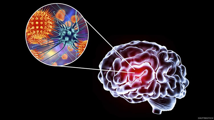 Can Cannabinoids Prevent Brain-Wasting Caused by HIV?